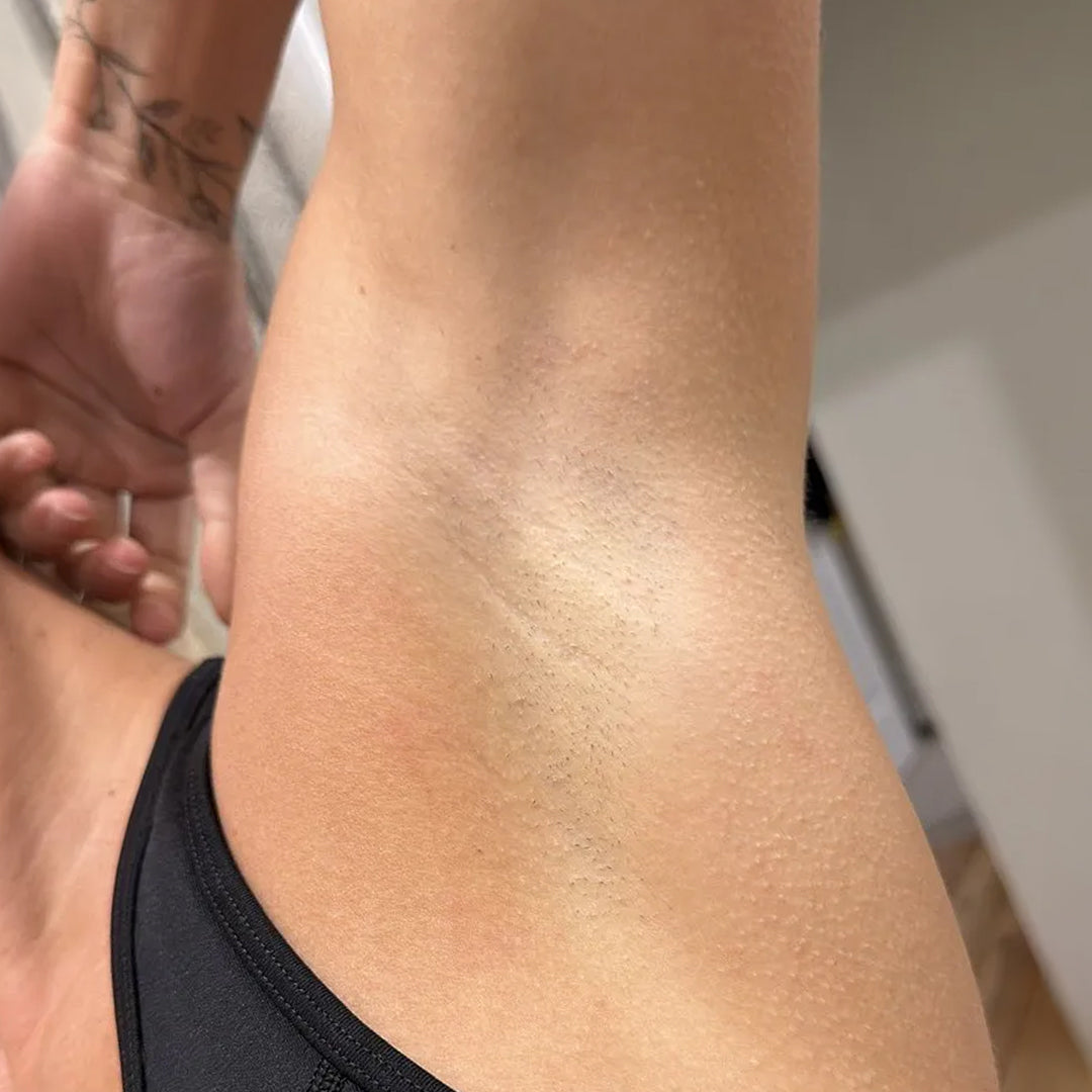 After using frank body AHA Deodorant: smooth, even underarm skin.