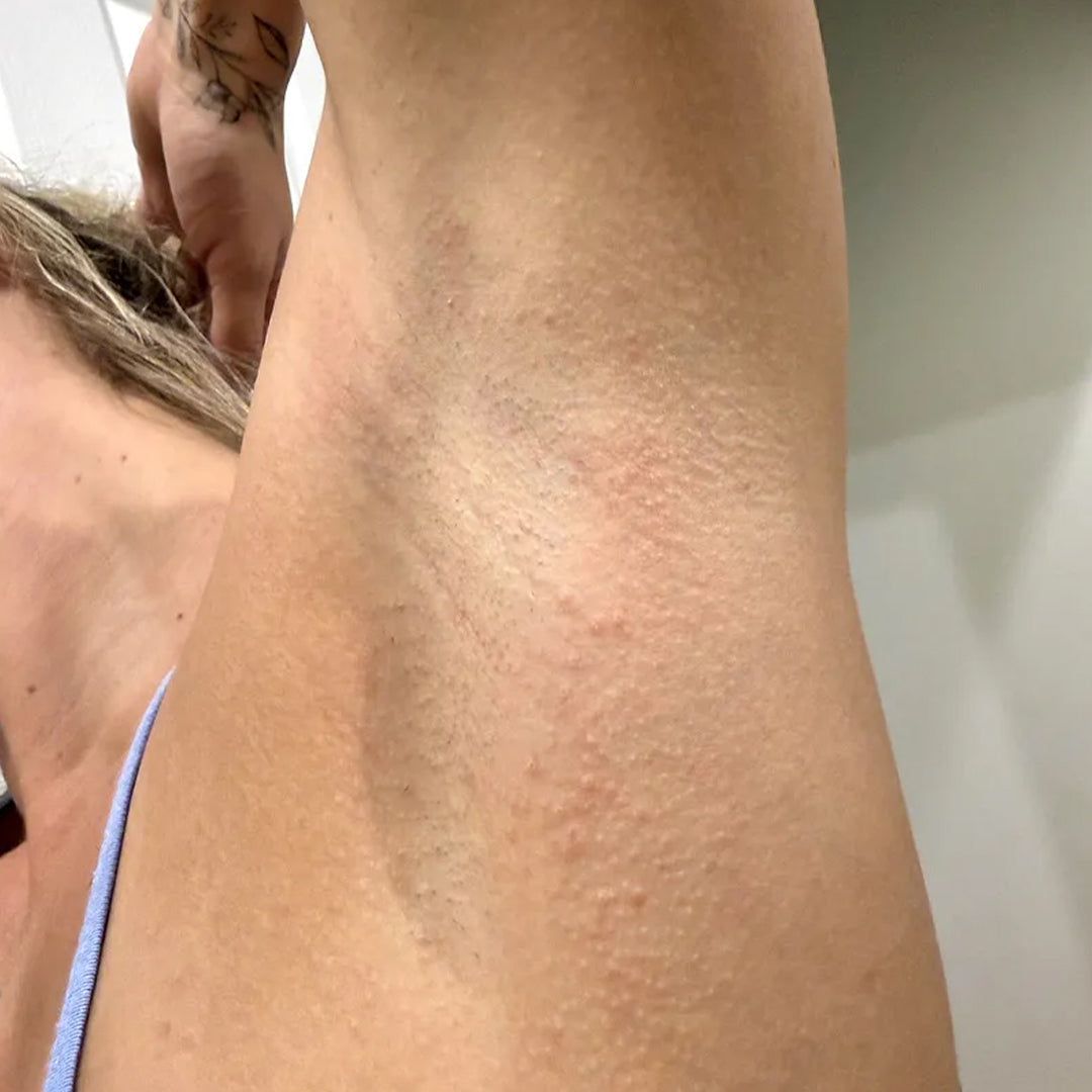 Before using frank body AHA Deodorant: rough texture and small bumps across the underarm.