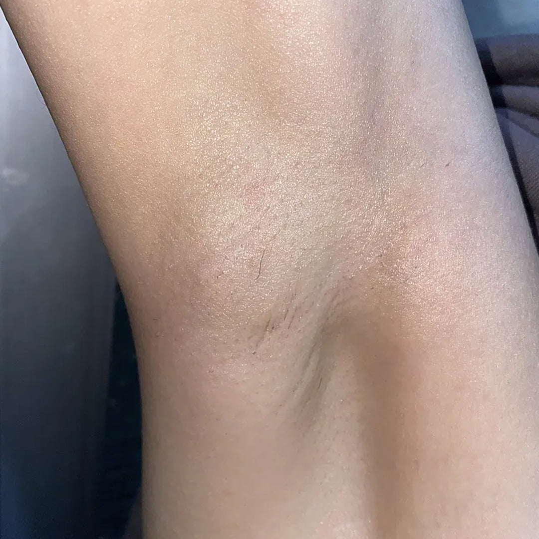 After using frank body Caffeine Deodorant: brighter, more even underarm skin.