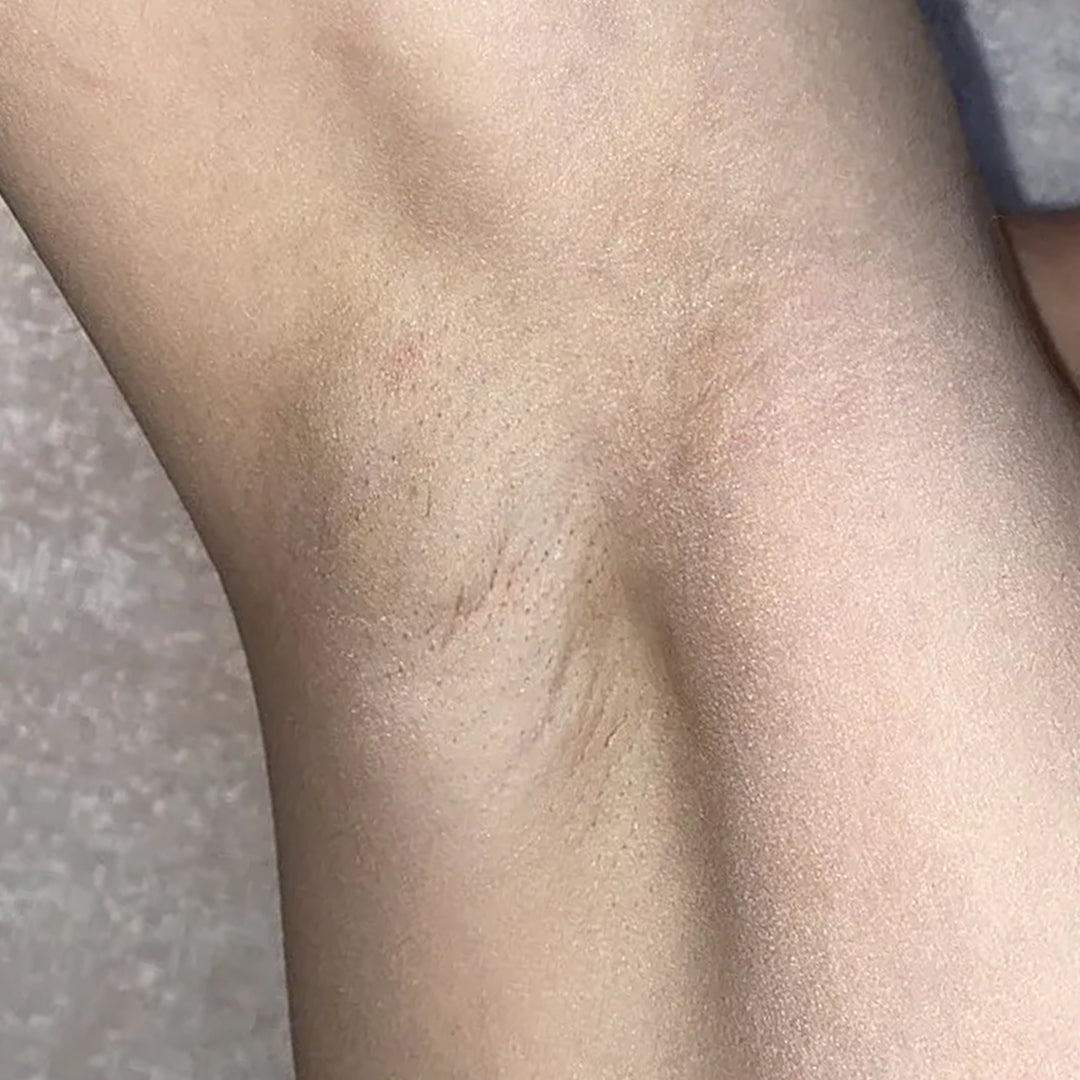 Before using frank body Caffeine Deodorant: darkened, uneven underarm skin.