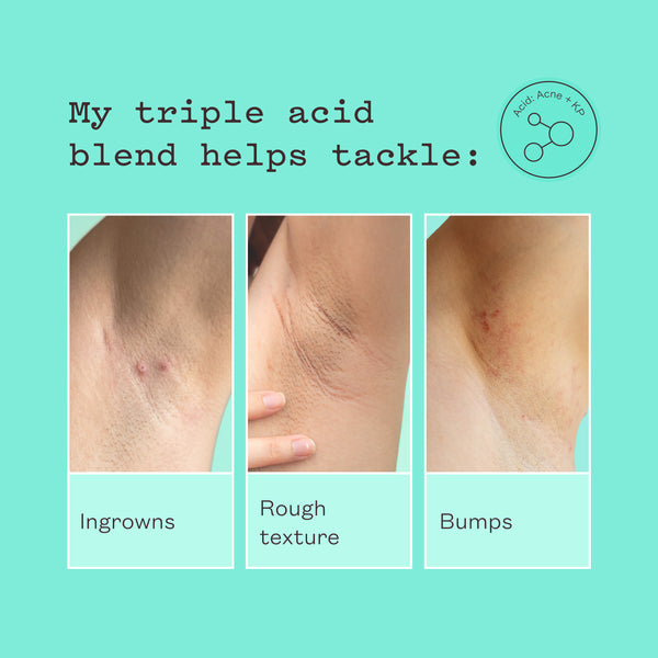 Close-ups of ingrowns, rough texture and bumps on underarm skin. Text reads: My triple acid blend helps tackle ingrowns, rough texture, bumps.