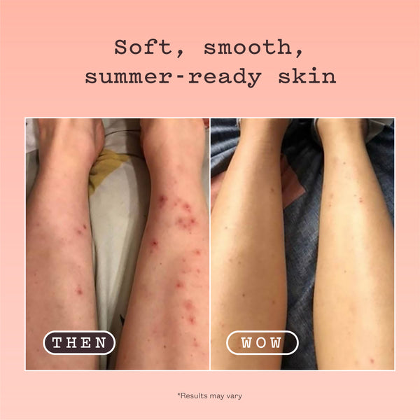 Before-and-after comparison of human legs showing skin condition improvement, with red blemishes on the left labeled 'THEN' and clearer skin on the right labeled 'WOW'. Text at the top reads 'Soft, smooth, summer-ready skin' and a small note says '*Results may vary'.